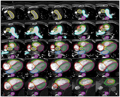 Advancements in cardiac structures segmentation: a comprehensive systematic review of deep learning in CT imaging